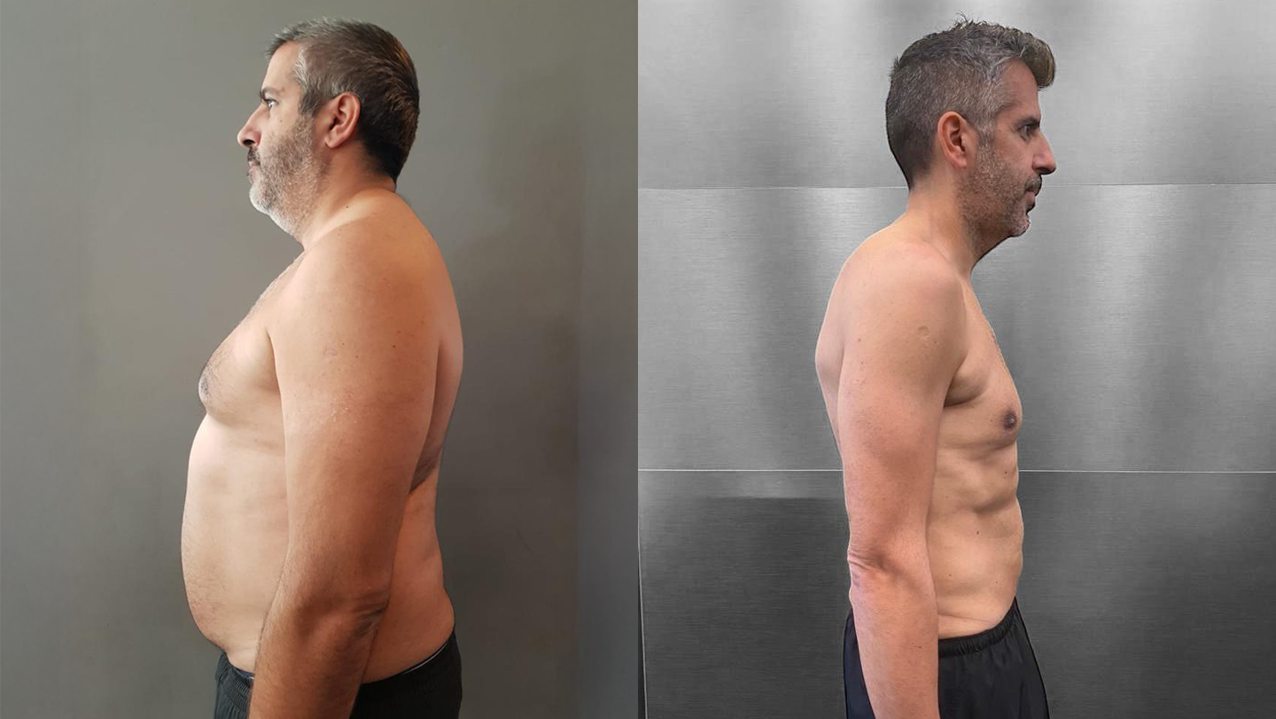 Antes e Depois | Fernando Matos