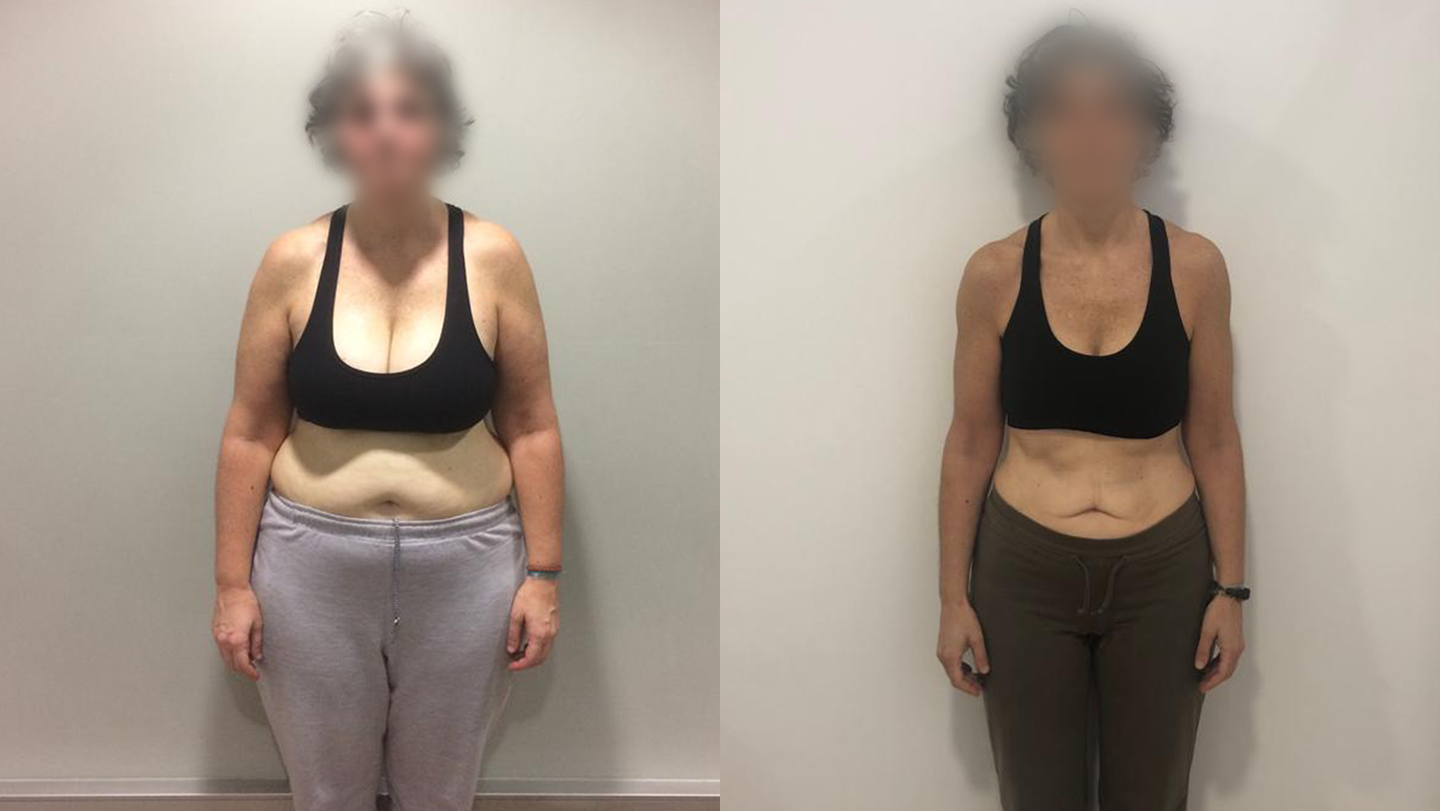 Antes e Depois Maria Lopes
