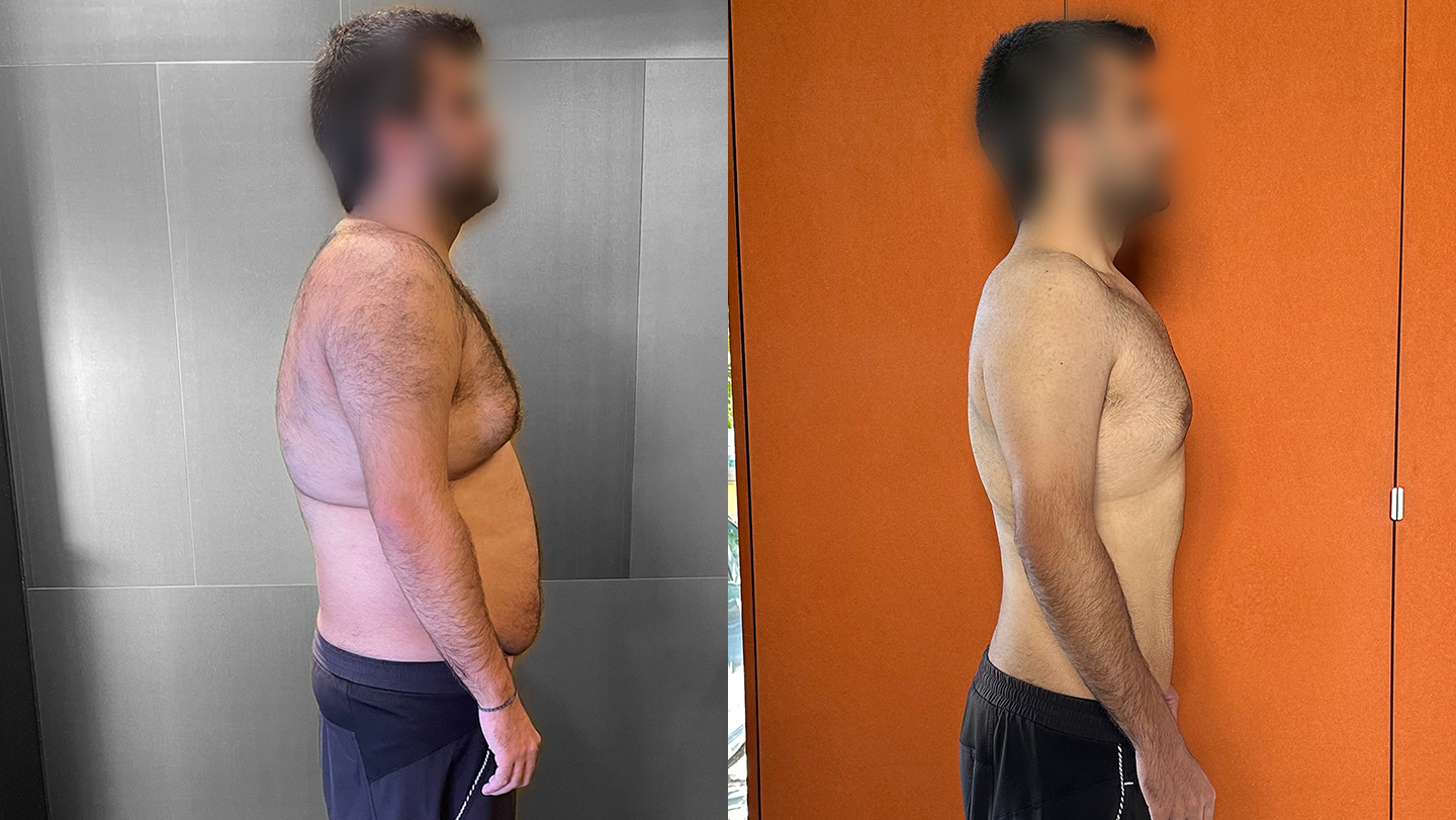Antes e Depois | Nuno